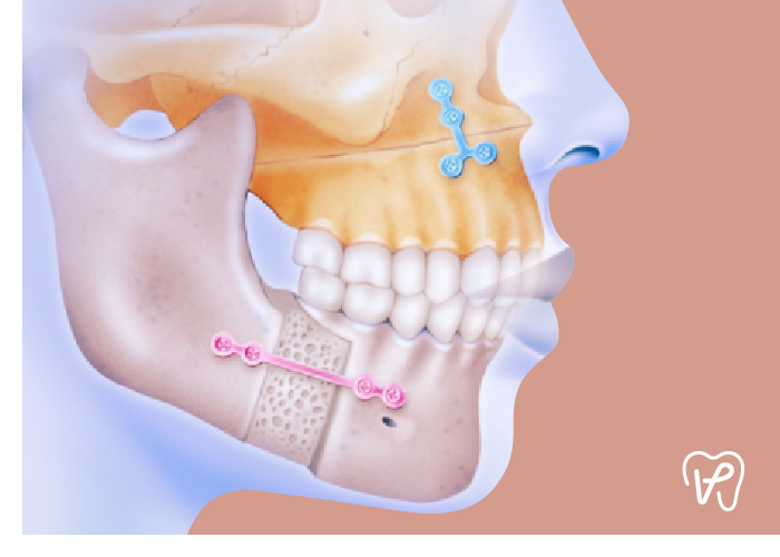 traitement chirurgie orthognathique traitement chirurgie orthognathique