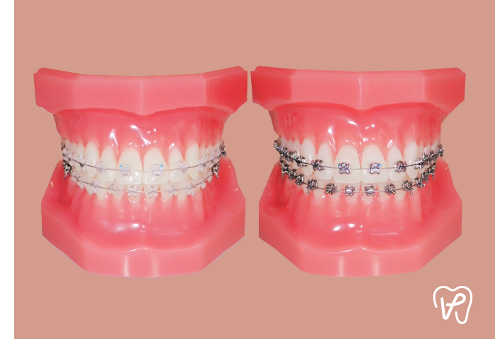 Traitement multi-attaches orthodontie Traitement multi-attaches orthodontie